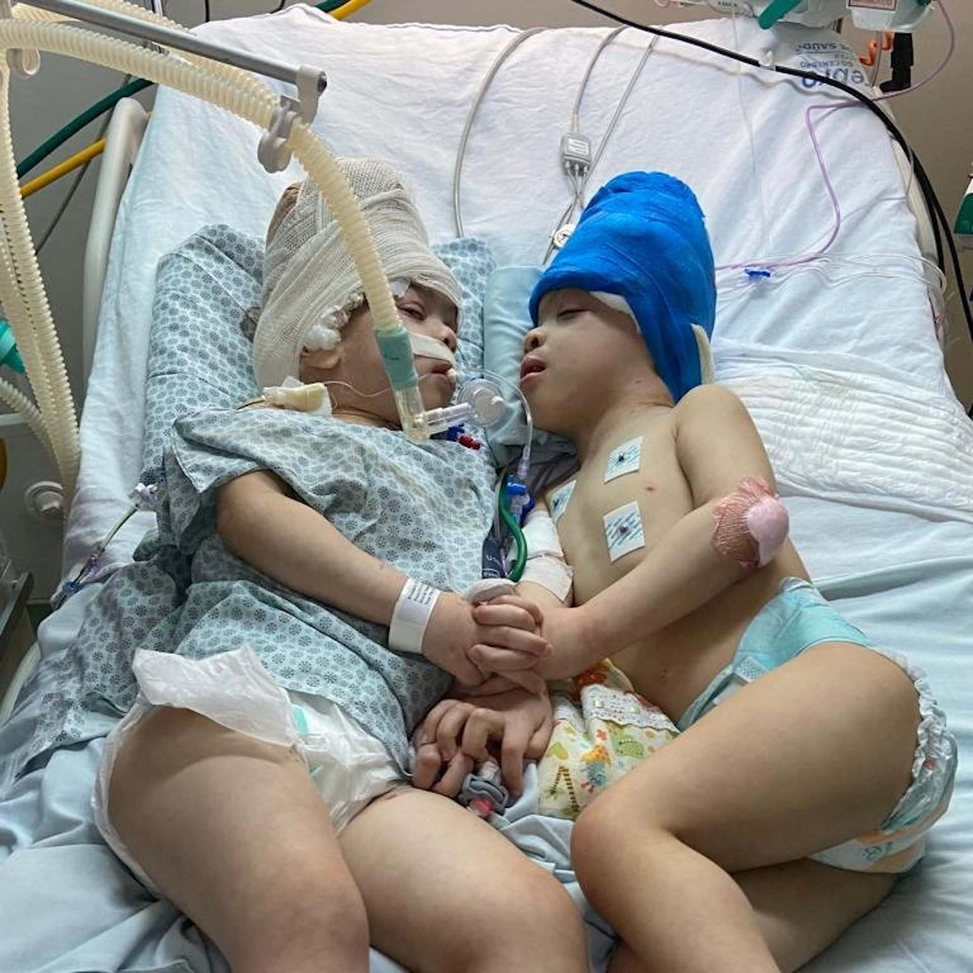 綜合外地媒體報導,巴西有一對3歲的頭部連體雙包胎近日接受分離手術。