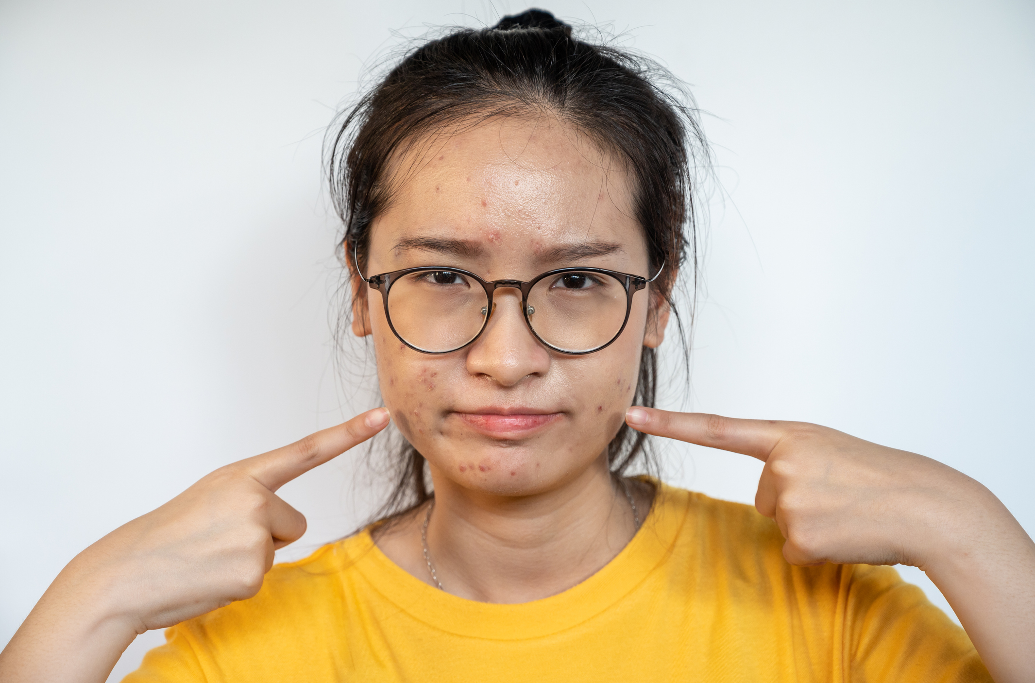 暗瘡在春夏天時候是爆發的季節。