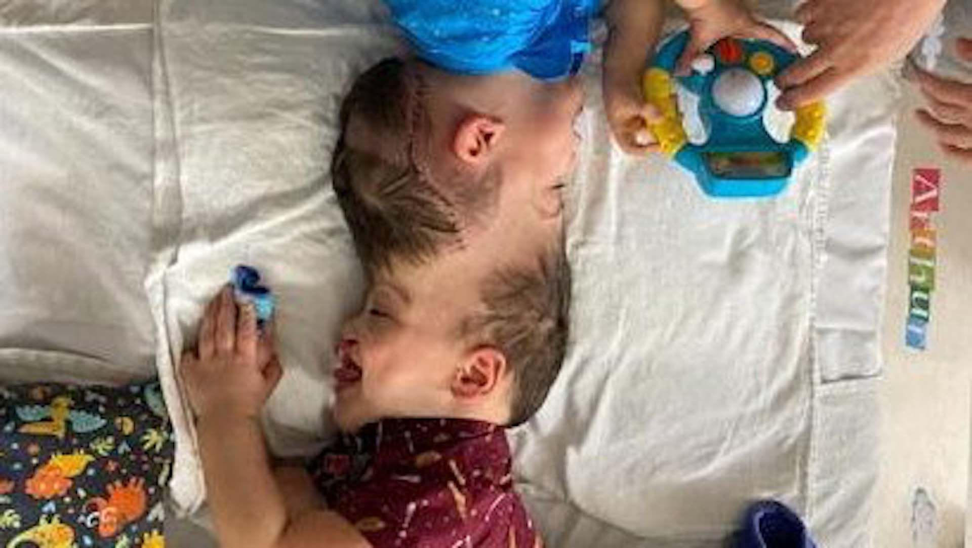 由於多條血管相連,因此分離手術難度極高。