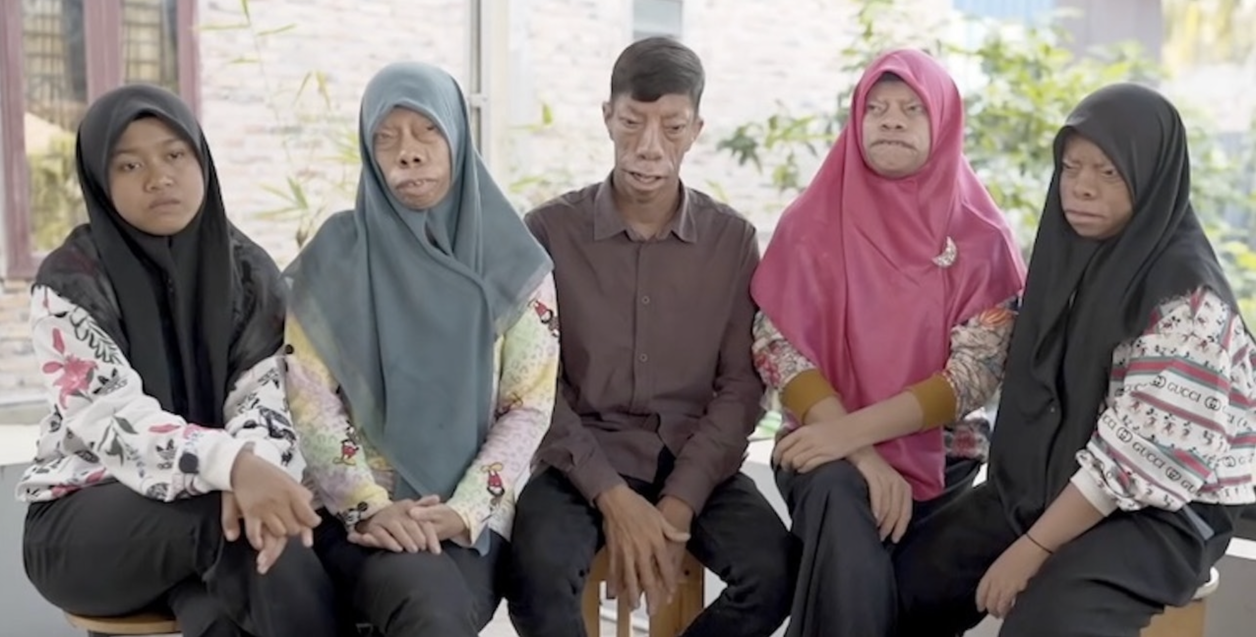 他們因長相怪異遭受歧視,被嘲笑是「河馬臉」。