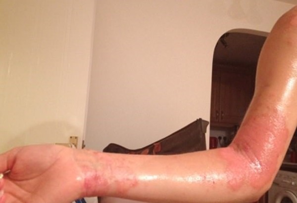 Camille上半身包括面部都長滿紅疹，令她痕癢難耐、流血紅腫，嚴重影響自信。