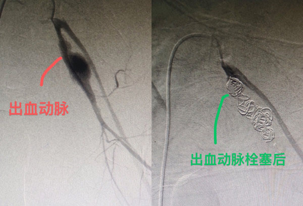 當時趙先生已失去意識、兩眼反白、每分鐘心跳率高達140次、血壓降至休克狀態。