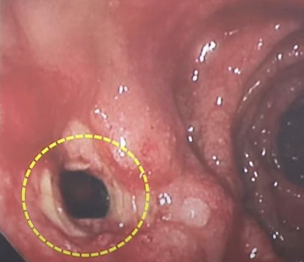 「內視鏡隱隱約約可以看到肝臟的結構,就是所謂的腸穿孔。」