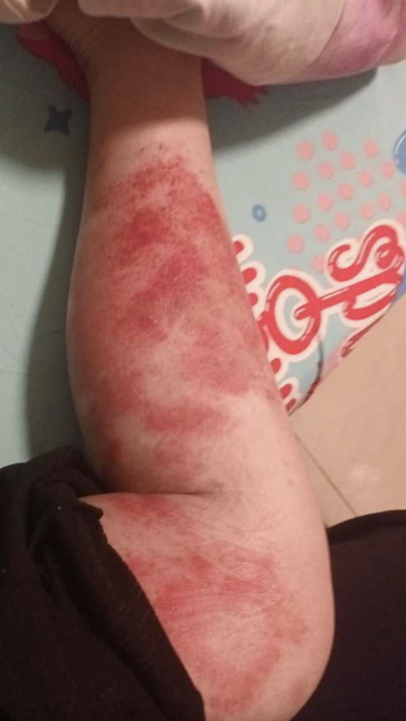 事主被蝨蟲叮咬至皮膚紅腫痕癢,直呼:好崩潰!