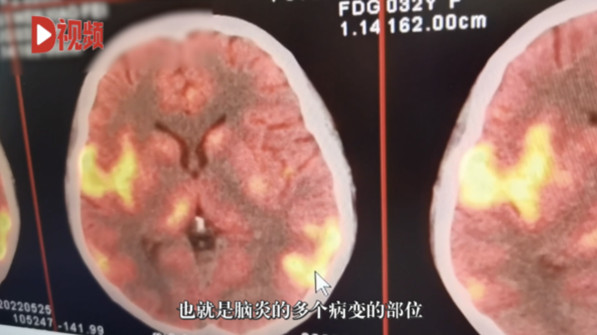 醫生從影像判斷,馮玉患上「自身免疫性腦炎」的可能性很大。