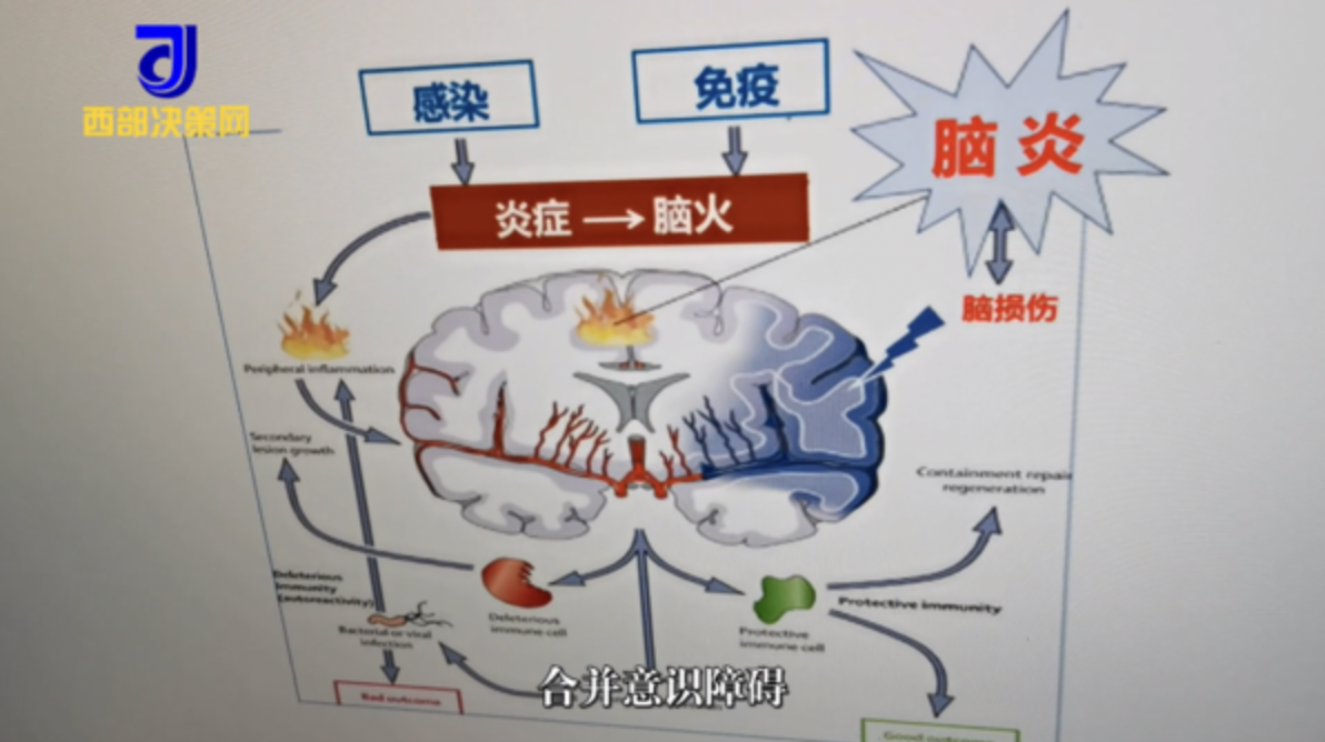 「抗GQ1b抗體相關腦炎」是神經系統病變的自身免疫性腦炎。