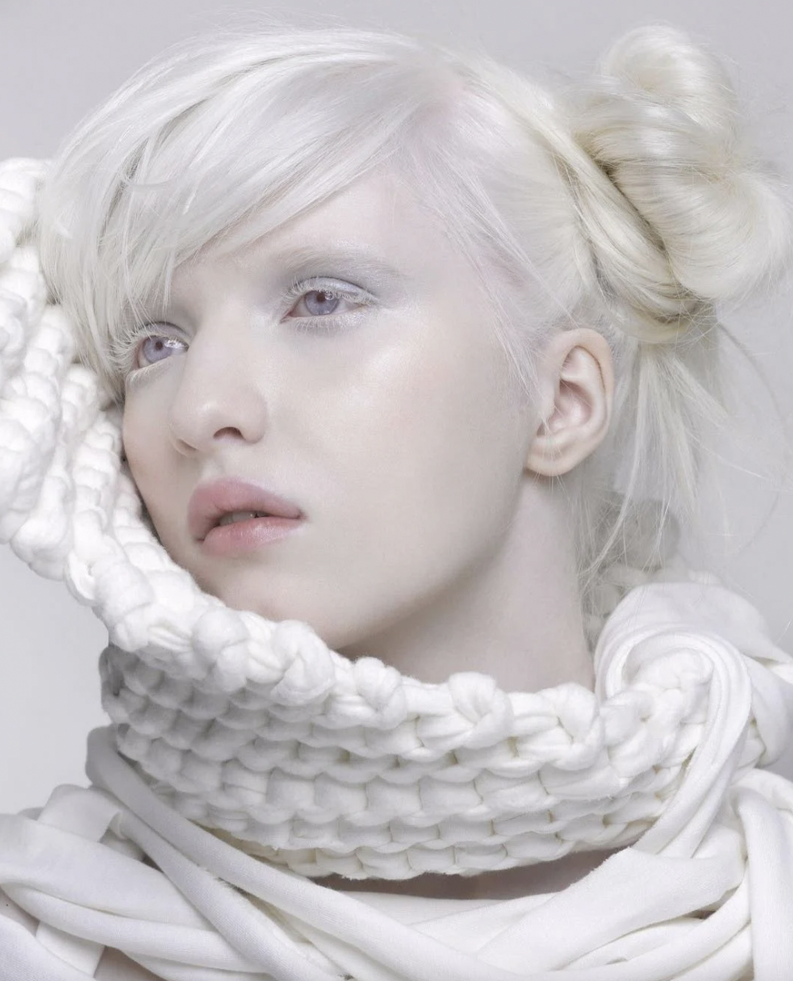 她因白化病眼睛非常畏光,視力也很差。