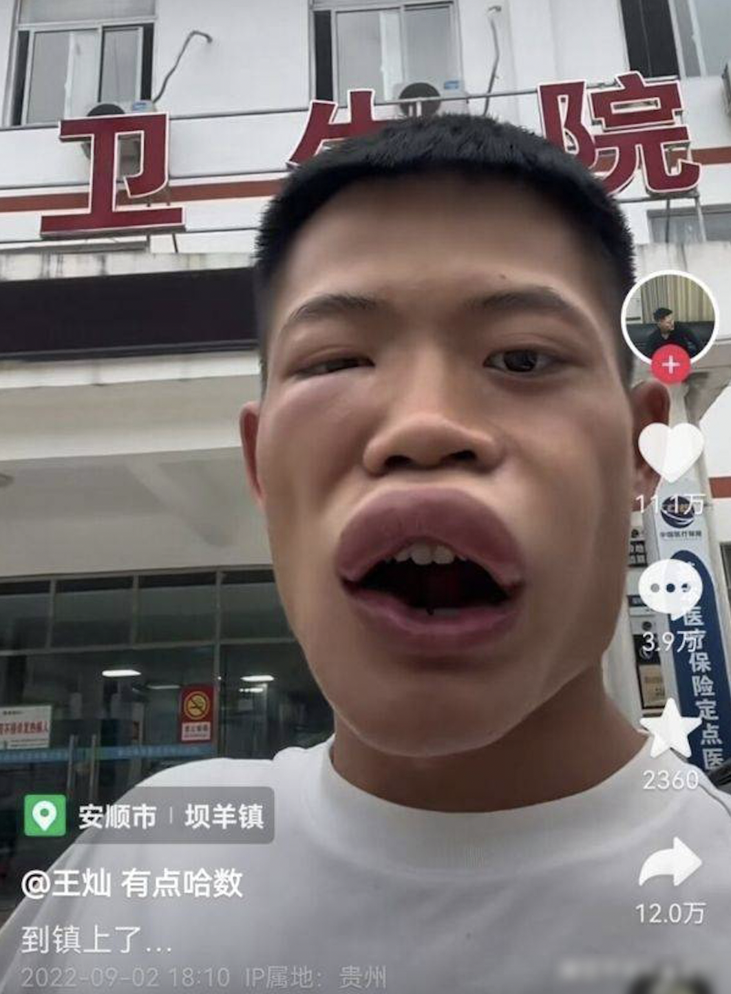男網紅下一秒看向鏡頭時,嘴巴已腫成香腸嘴。