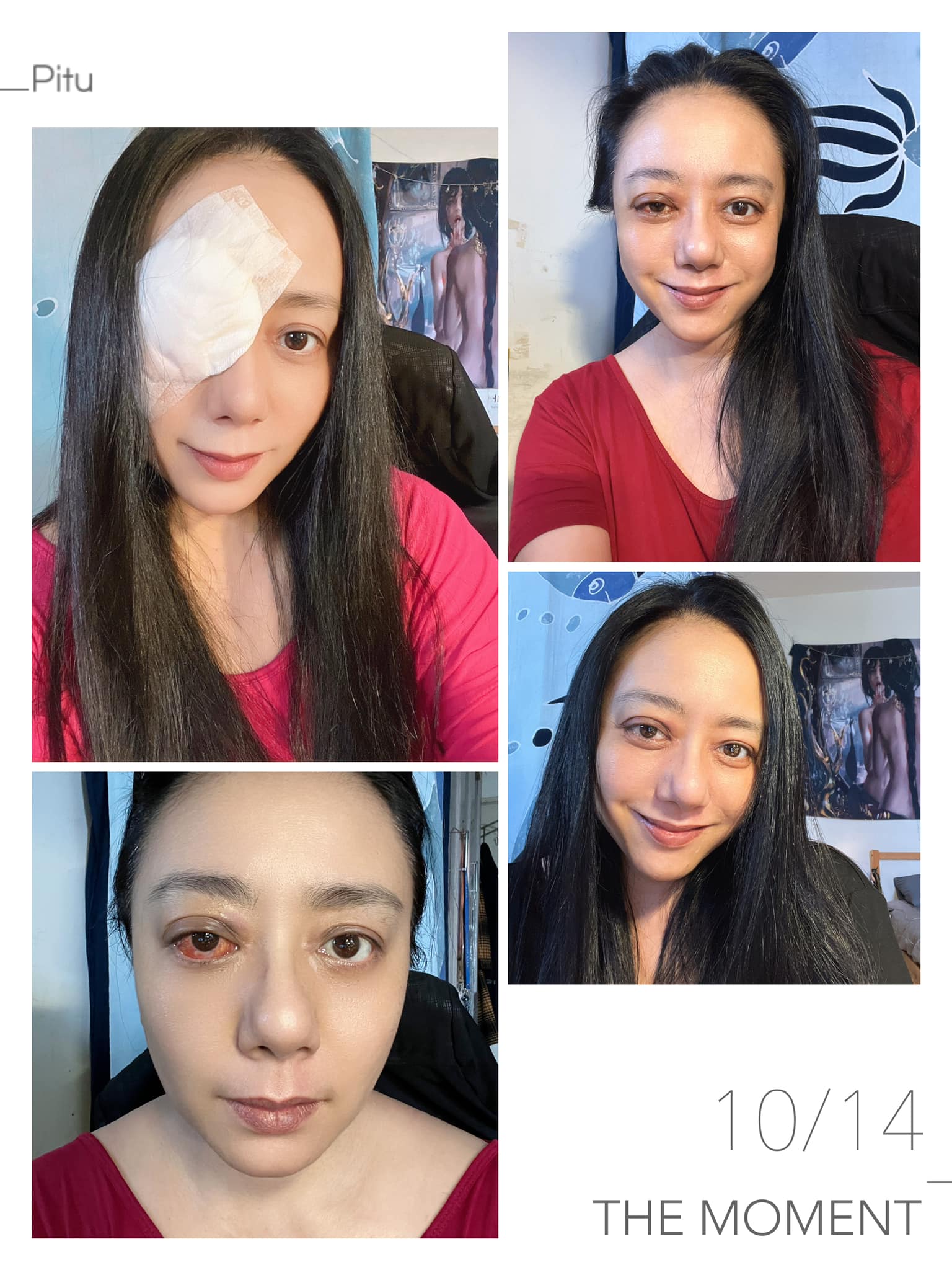 昨日(16日)高慧君首次貼出手術後的照片。