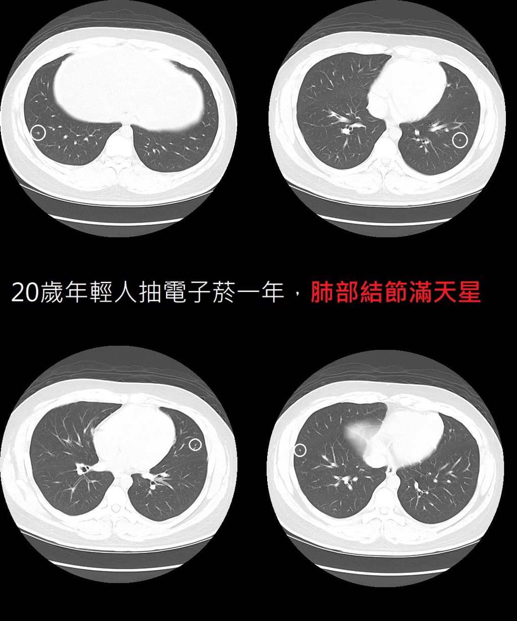 男子的肺部出現「滿天星」肺結節。