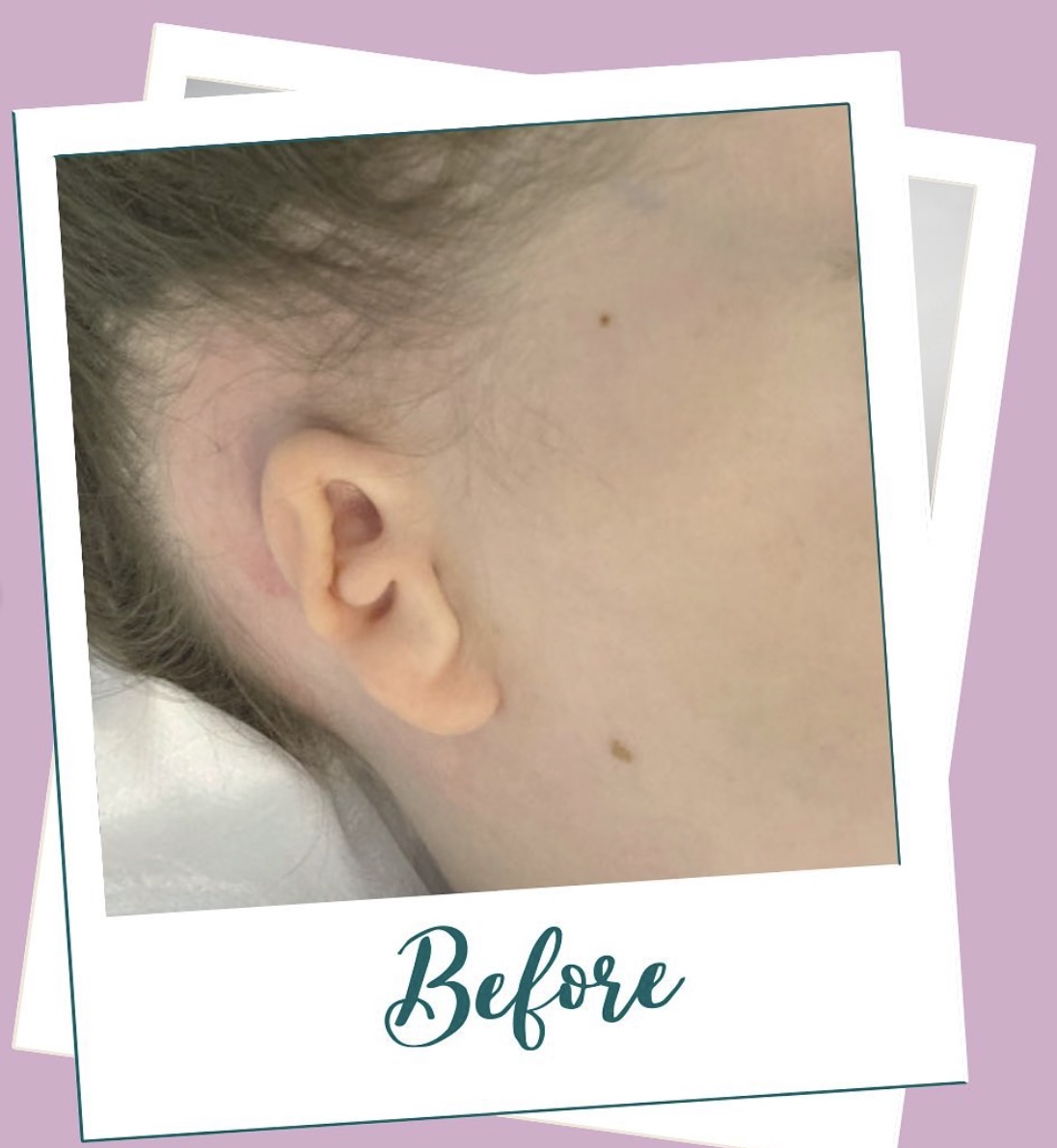 女童天生單邊無耳朵，另一邊耳朵亦不健全。