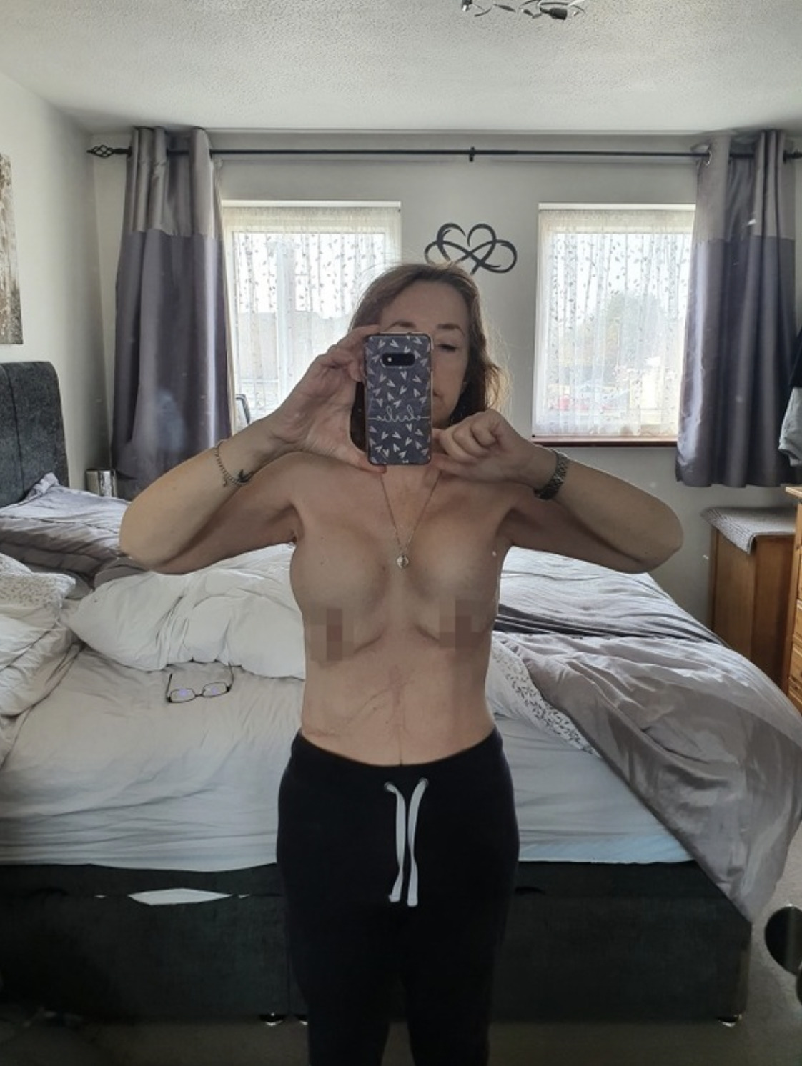 手術失敗慘變「4個乳房」。