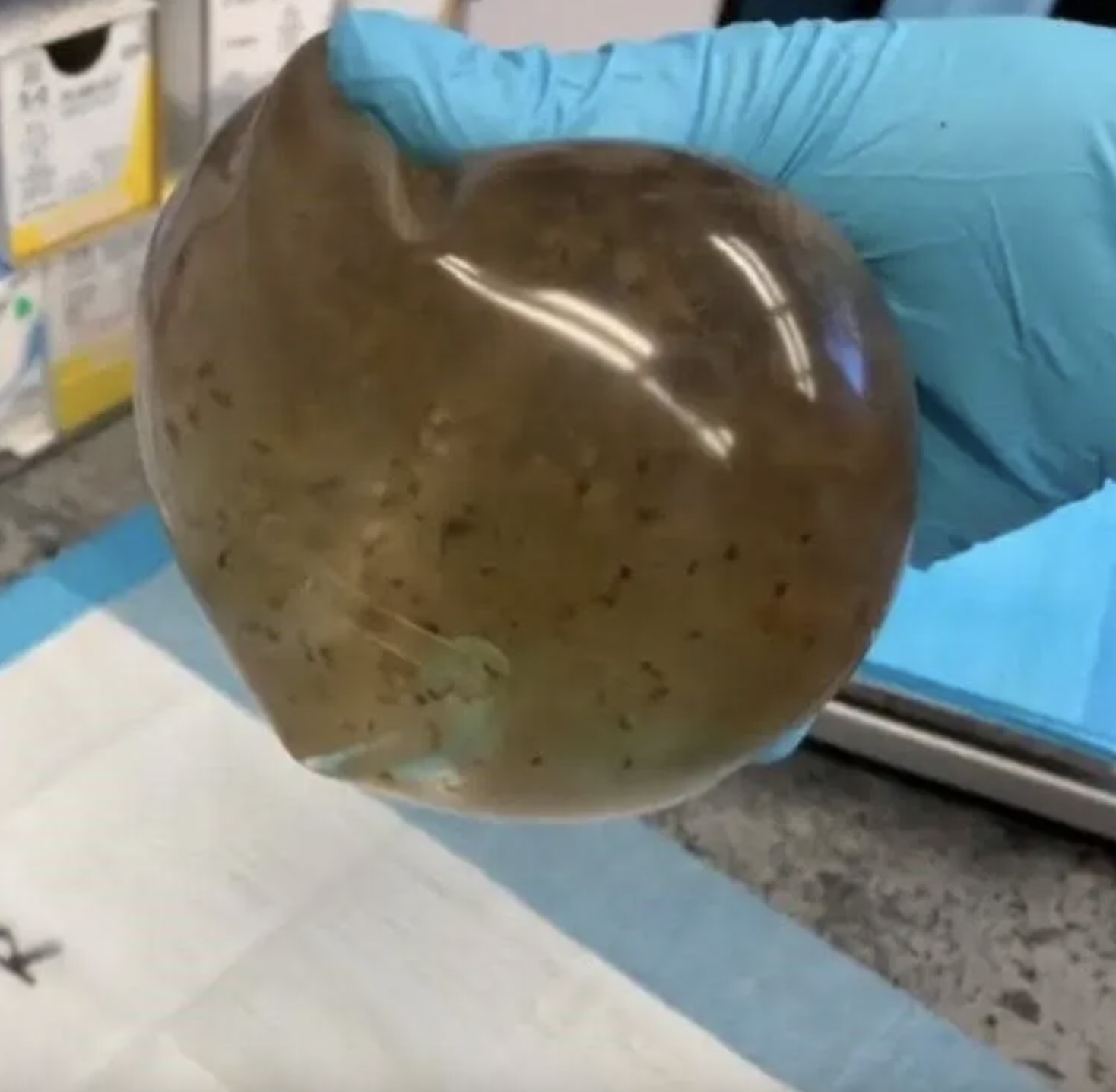 乳房內的鹽水袋早已「發霉腐爛」。