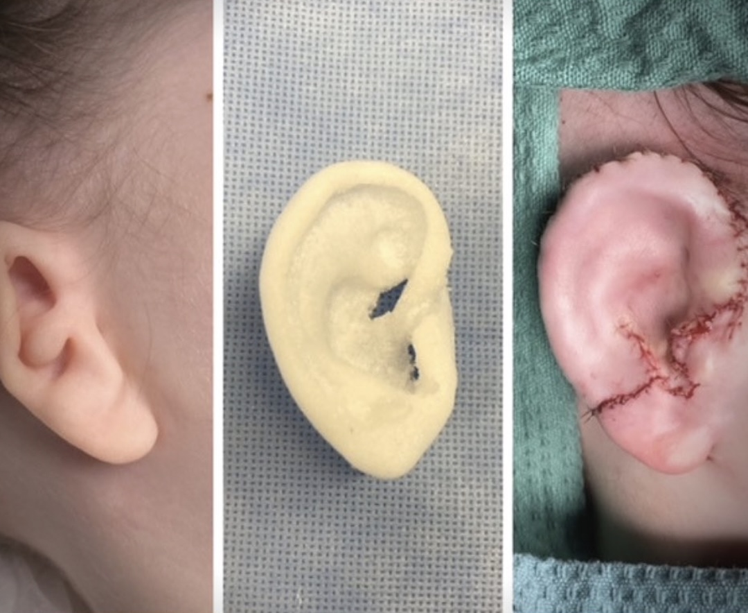 醫生用媽媽的耳形來制模。