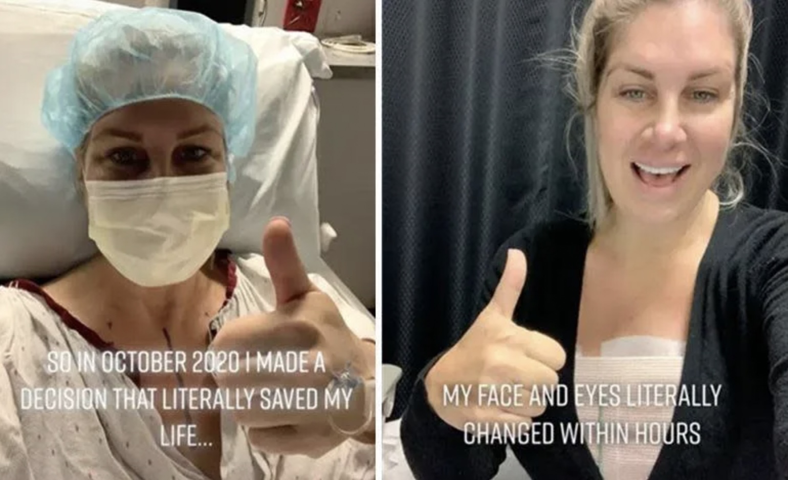 美國一名女子20年前進行隆胸手術後，不斷開始出現各種可怕的後遺症。