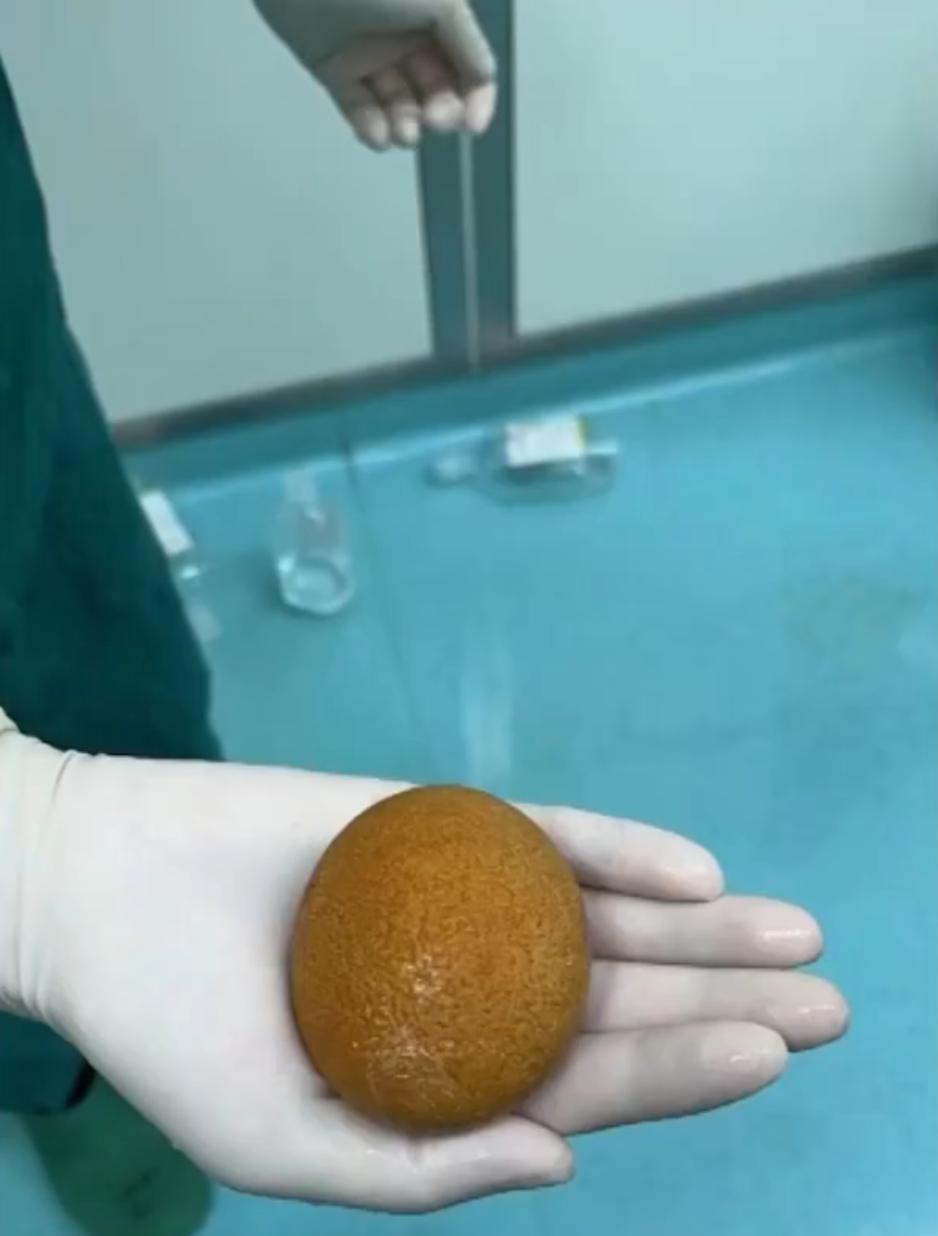 醫生為王先生進行手術後，取出一粒有如「鵝蛋」般大的巨型結石。