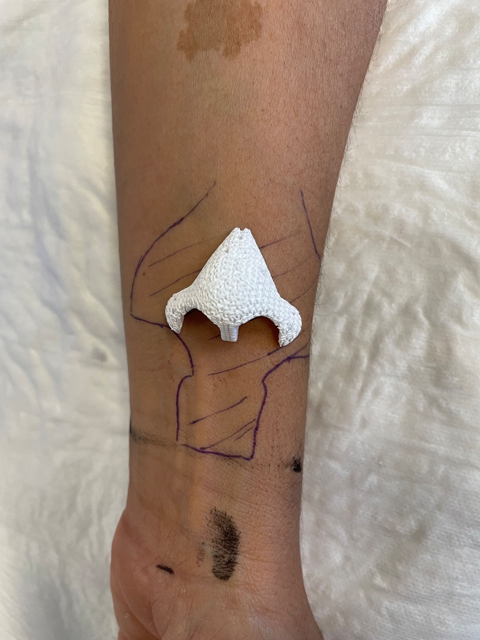 法國女子Carine於2013年罹患鼻竇癌，失去大部分鼻子和上顎前部，形成顏面損傷。