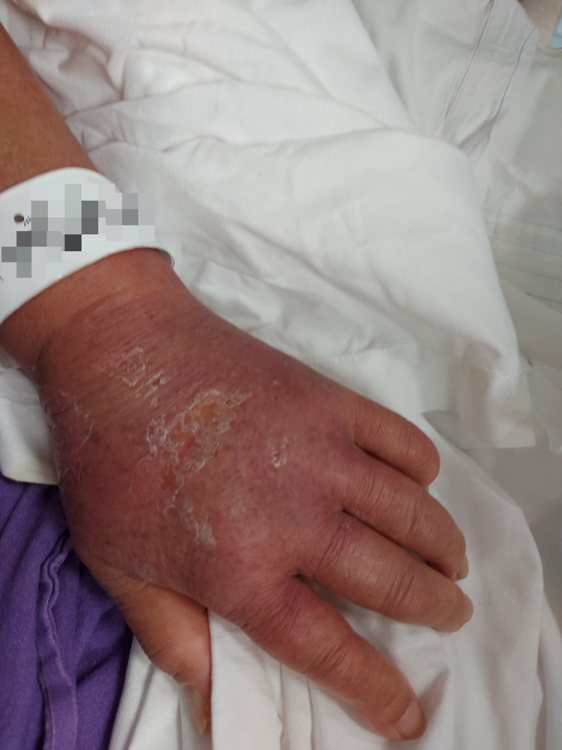 許婆婆服用藥物後一個月後,開始出現嚴重副作用,先後出現頸腫、發燒及皮膚紅疹等過敏反應。