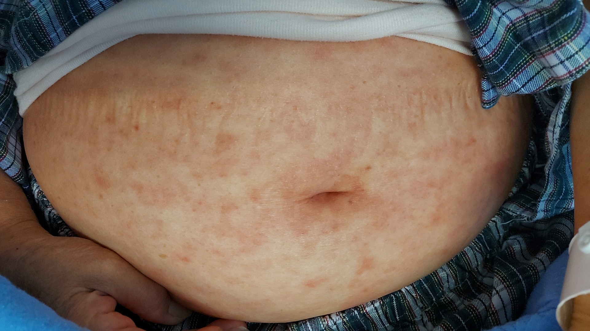 許婆婆停藥後仍陸續出現皮膚紅疹、痱滋等,被診斷患「史蒂芬強生症候群 (SJS)」,身上多處皮膚脫落潰爛。