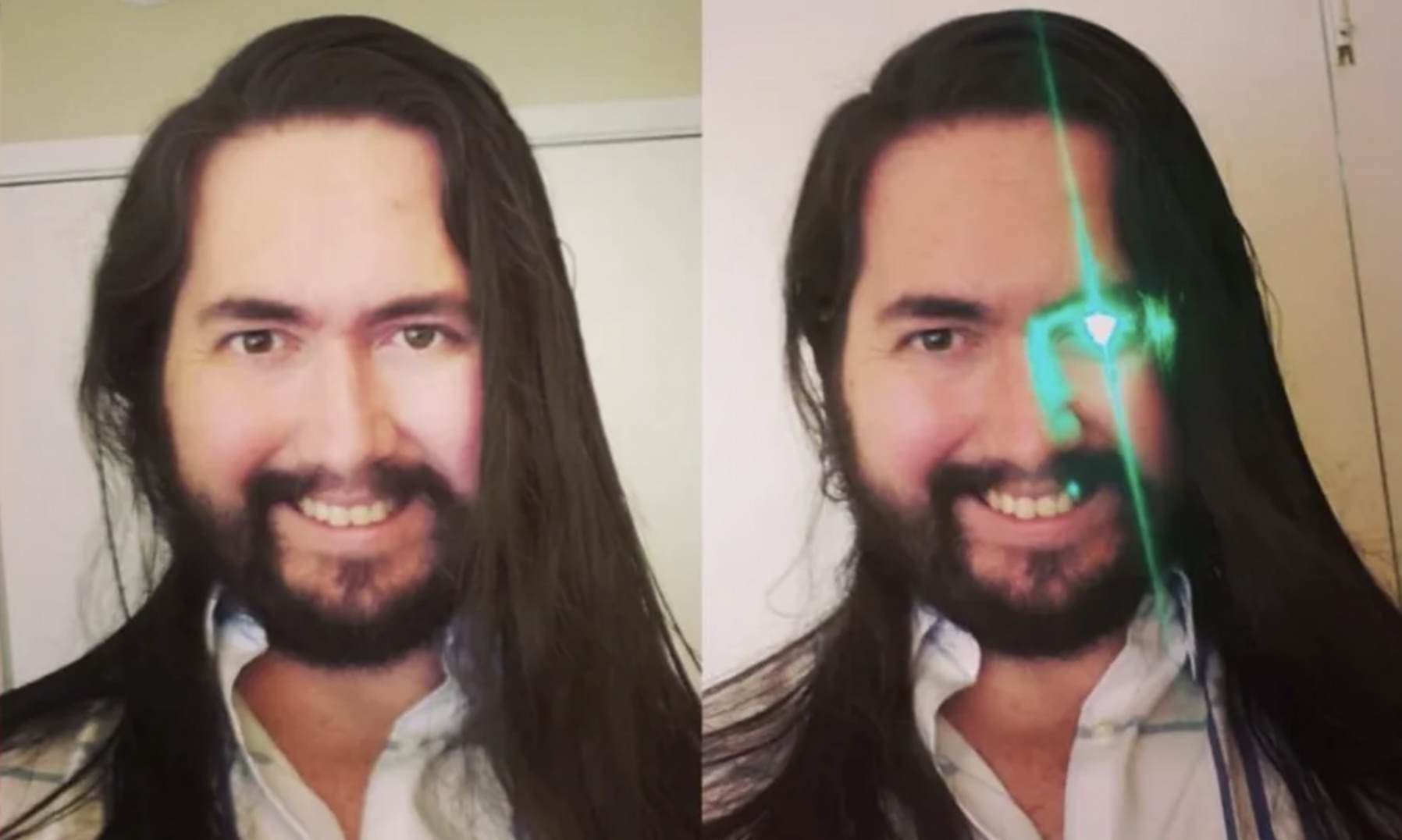 美國有一名33歲男子因為罹患視網膜母細胞瘤,失去了左眼。