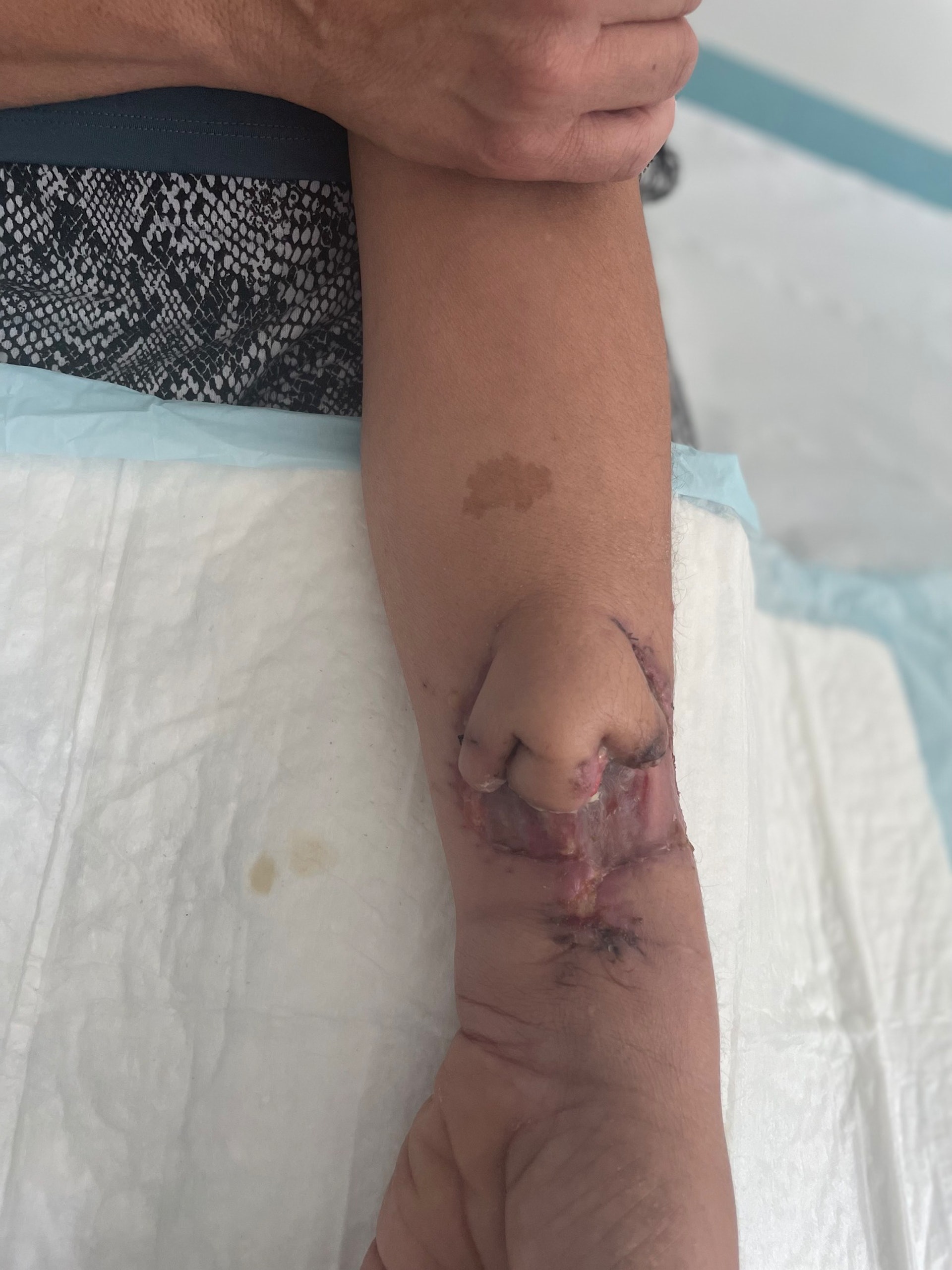 鼻腔癌女患者憑3D打印技術 成功手臂重建鼻子。