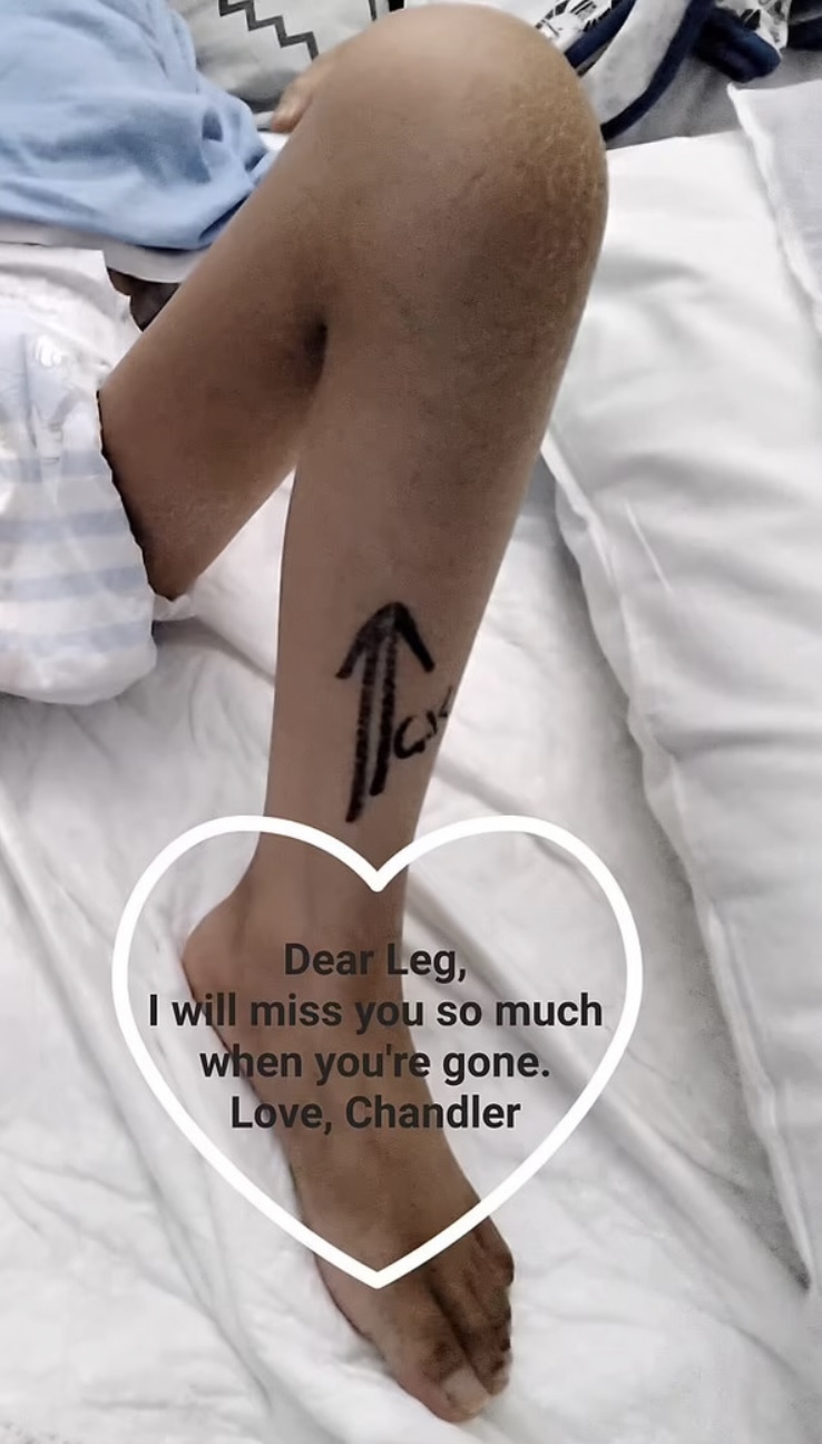 醫生表示，Chandler的癌細胞擴散需即時接受截肢手術。