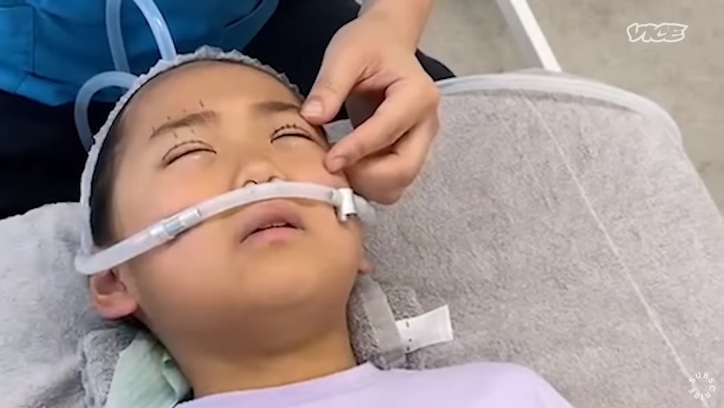 9歲女兒在接受雙眼皮手術的過程。