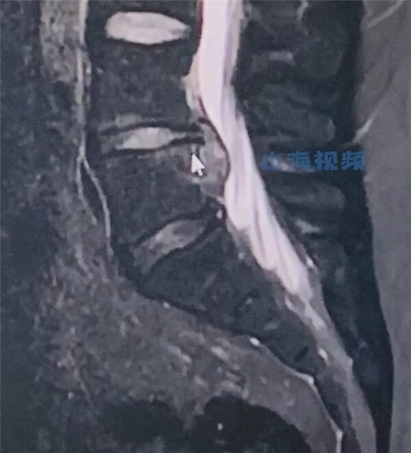 經檢查發現他的尾椎骨斷裂,需要住院一週。