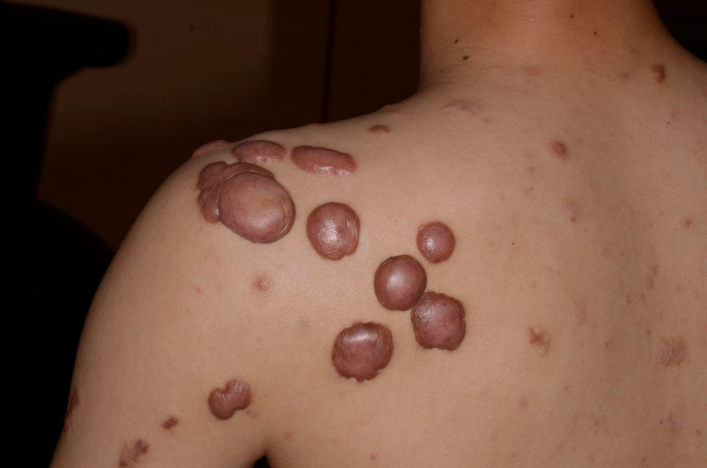 患者的皮膚受損部位,因幫助傷口癒合的細胞過度增生,而形成蟹爪一樣的突出疤痕。