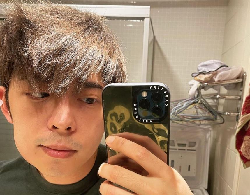 Edan上週六（17日）在社交平台分享多張早前剝智慧齒後一邊臉腫的照片。