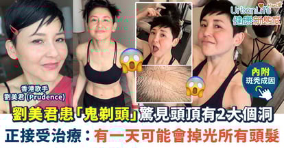 【斑秃成因】劉美君患「鬼剃頭」驚見頭頂有2大個洞 正接受治療:有一天可能會掉光所有頭髮