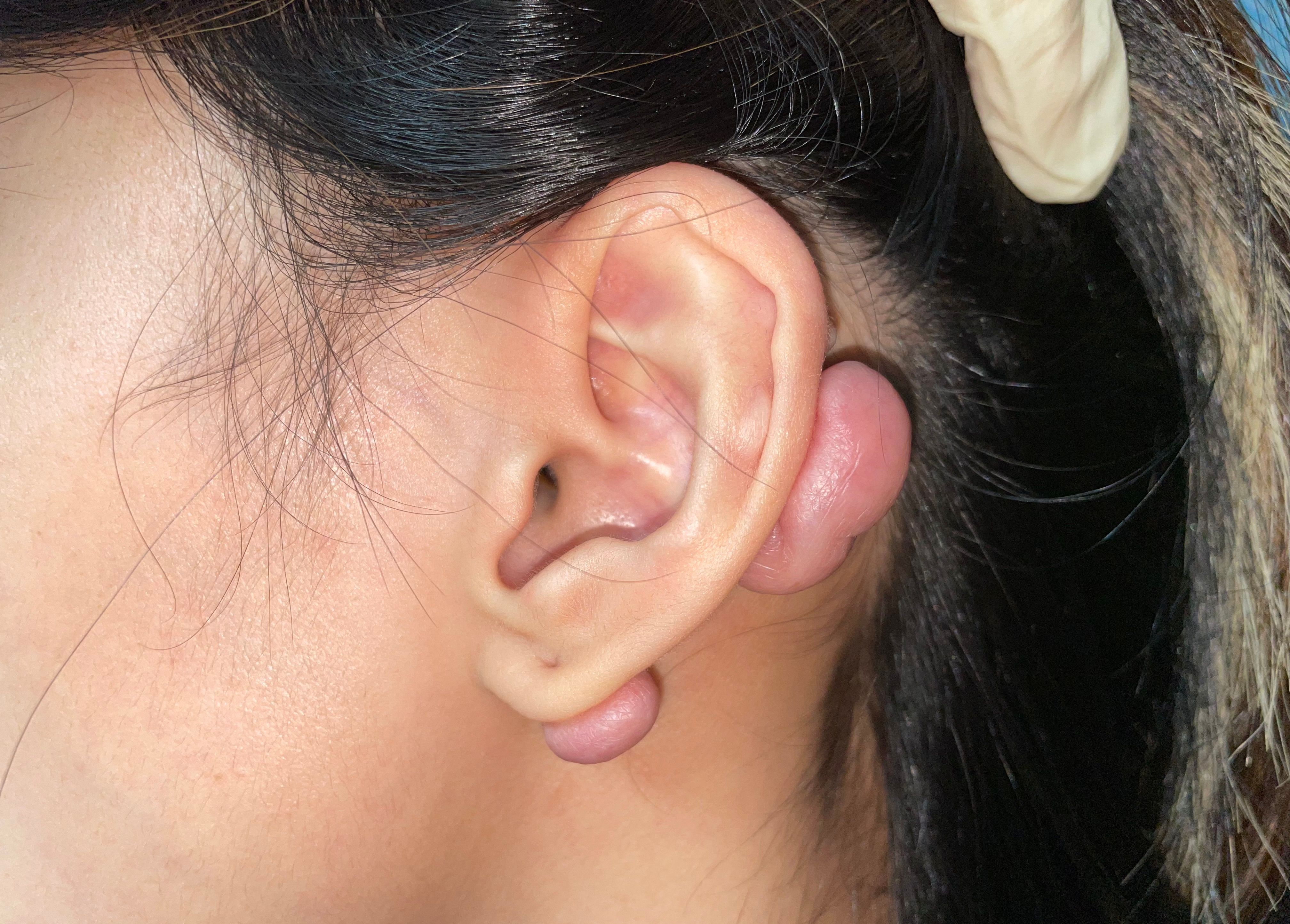 蟹足腫常見於手臂、耳朵、肩背部、胸口等位置。