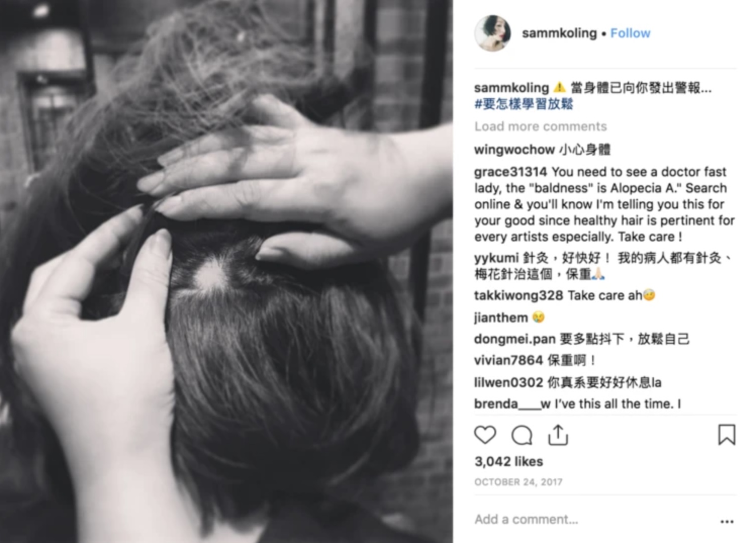 早年曾兩度出現「鬼剃頭」情況。