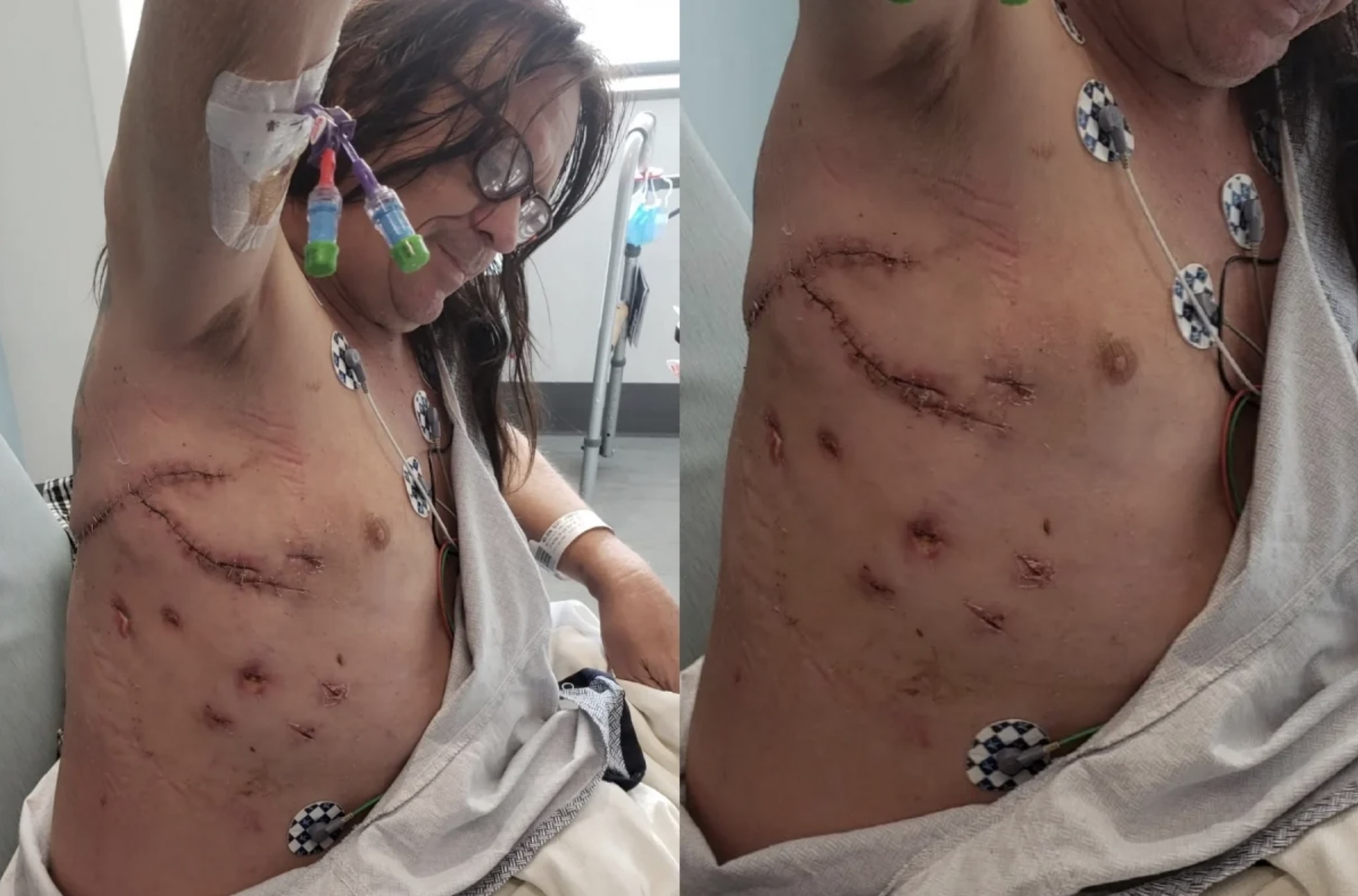 Nelson在社交平台Facebook公開了傷勢照片，展示身體右側的傷口縫線。