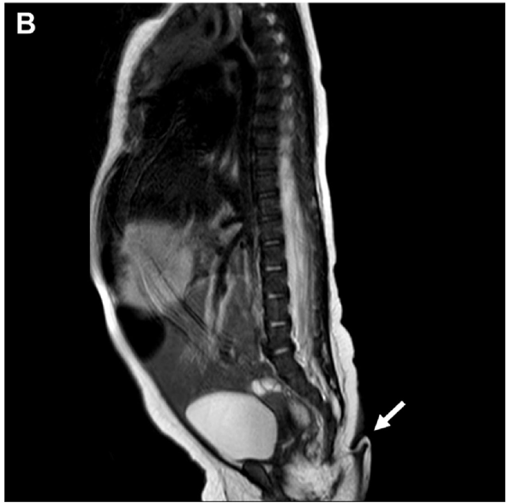 經檢查發現，女嬰的「尾巴」主要由脂肪和皮肉組織所組成。