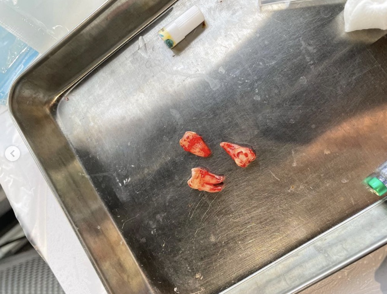 Edan還上載了「血齒」照片，有一隻還被分了2半。