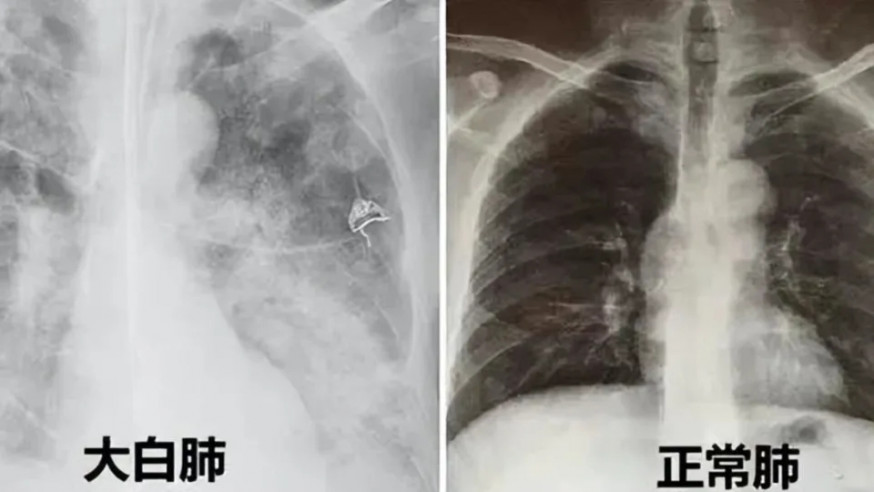 近日有傳內地確診者的CT(電腦斷層掃描)驚現「白肺」,疑因原始病毒株又再出現而致。
