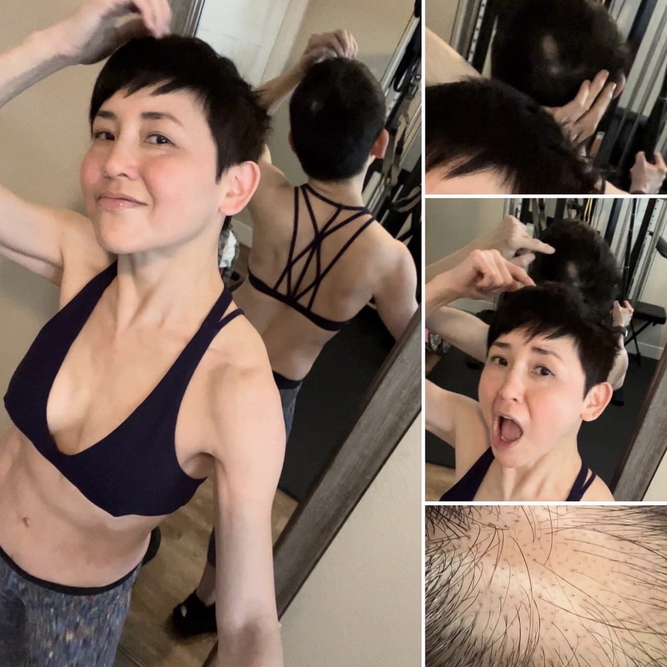 劉美君日前在社交平台IG透露自己患上俗稱「鬼剃頭」的斑秃。