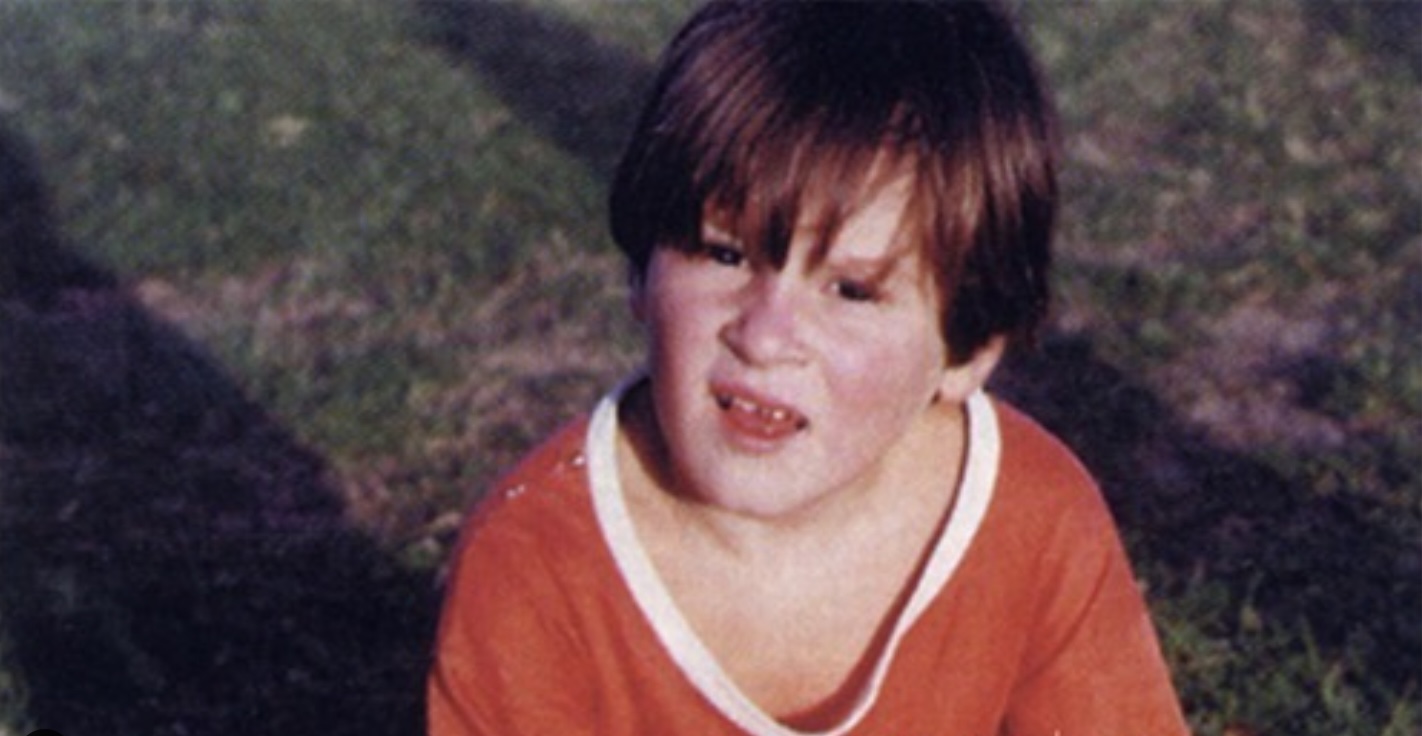 美斯兒時被診斷出患上「侏儒症」。