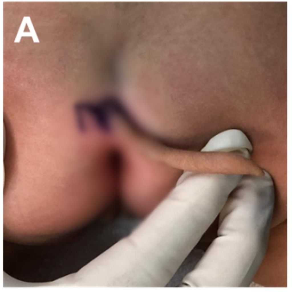 女嬰在2個月大時，「尾巴」竟再增長0.8厘米。