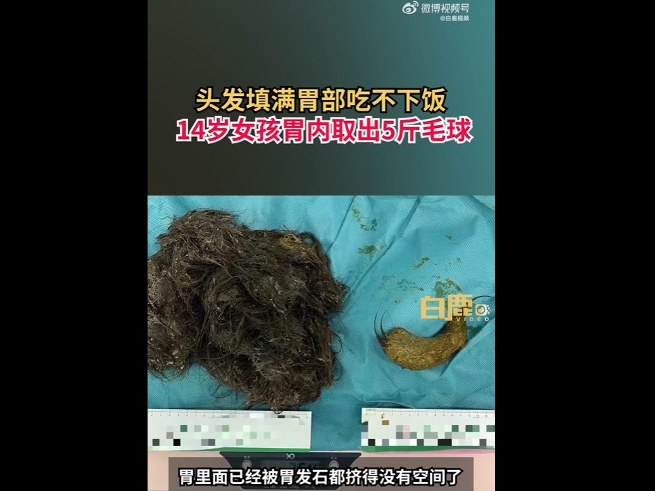 醫生在小安的胃部發現一塊重達2.5公斤的「胃髮石」。
