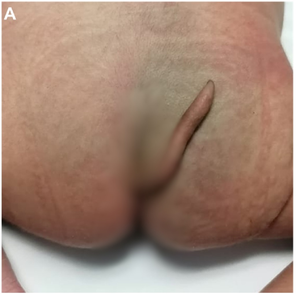 女嬰的屁股後面長了一條約5.7厘米的不明組織。