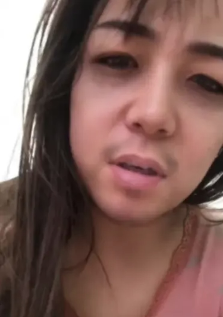 女子表示「鬍子燒出來還沒有下去，黑眼圈也下不去」。