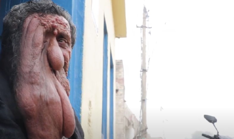 Govardhan Das患上這種罕見的疾病被稱爲Von Recklinghausen’s disease。