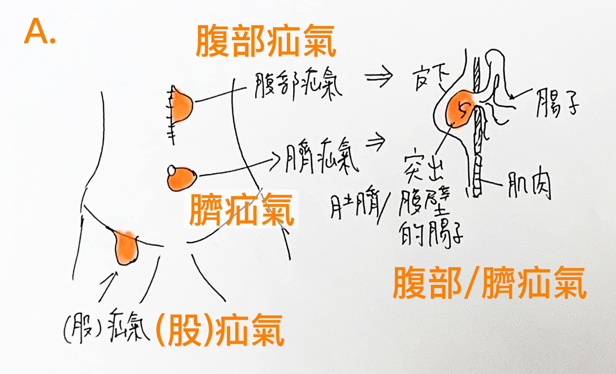 陳志金醫師親自繪圖解說。