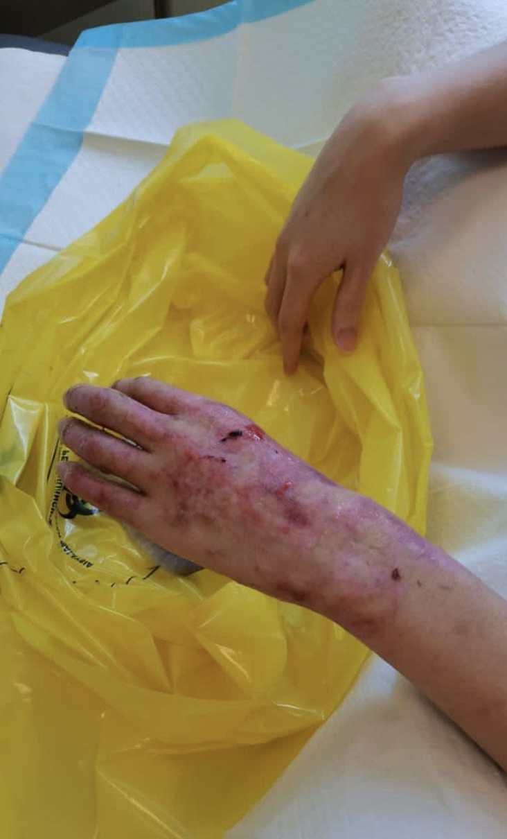 手部也嚴重燒傷。