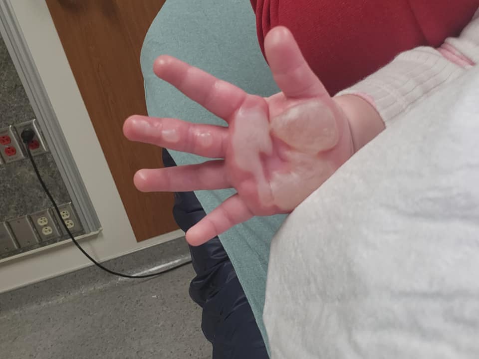 寶寶1%二度燒傷的手掌與大大小小的水泡。