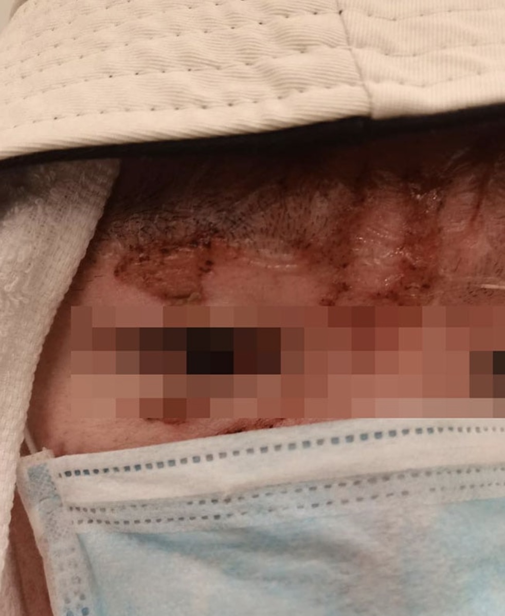 眉毛也被燒沒了。