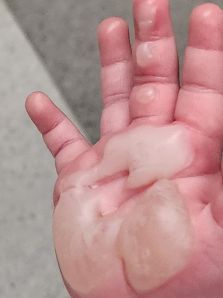 寶寶燒傷的手掌。