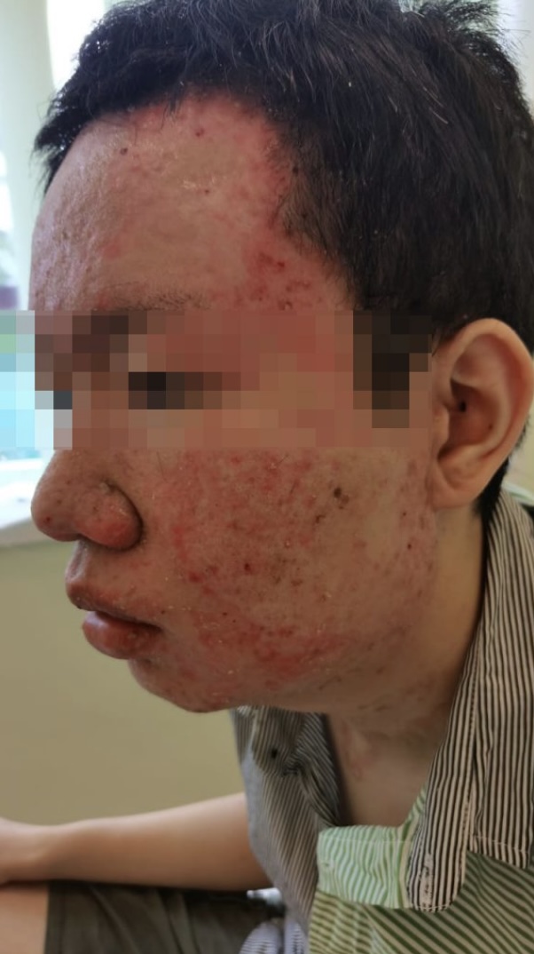 酒精隨著爆炸聲飛濺到丘漢琛的臉和手。